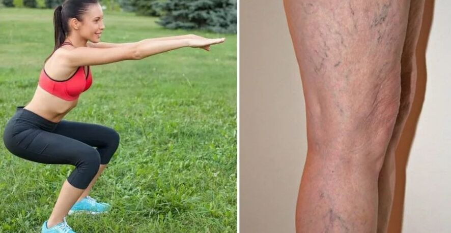Gambe per vene varicose
