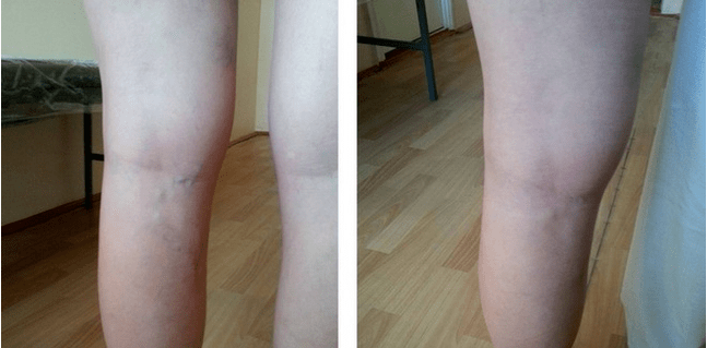 vene varicose sulle gambe